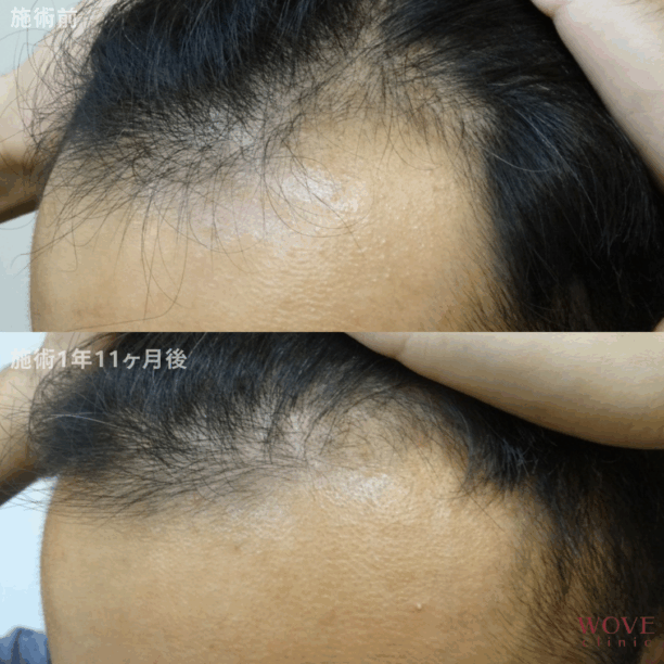 育毛メソセラピー24回