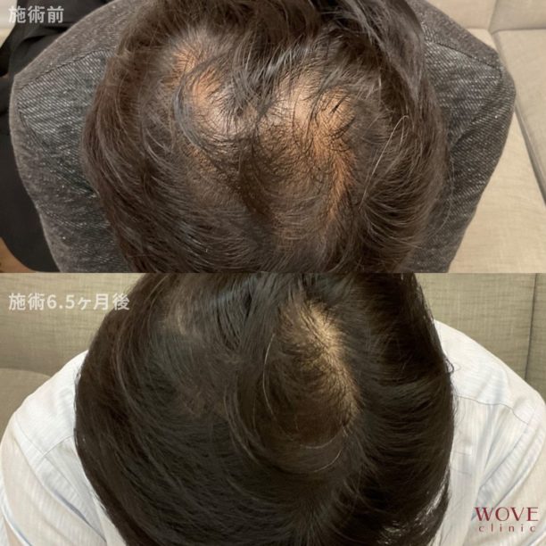 育毛メソセラピー11回