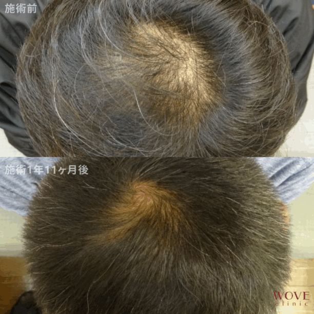 育毛メソセラピー24回