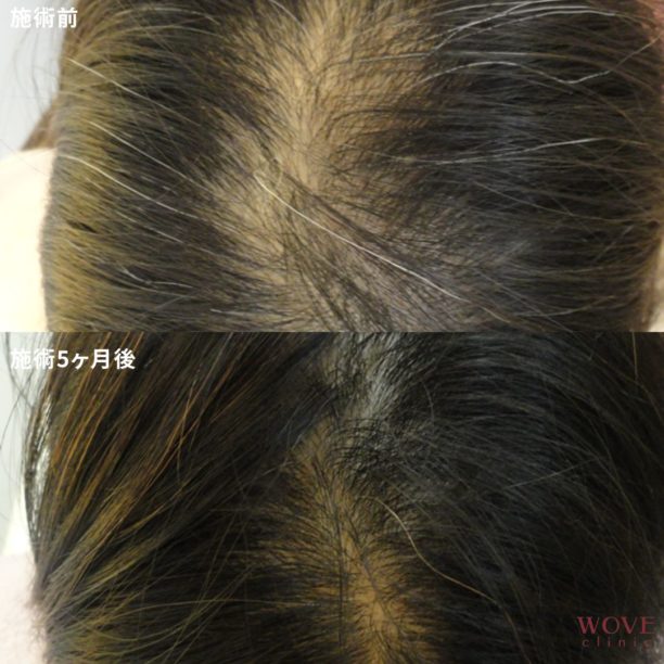 育毛メソセラピー6回