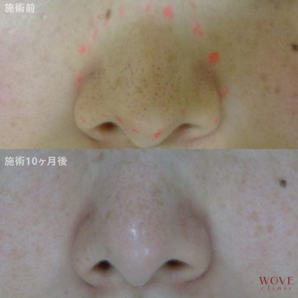 ケミカルピーリング＆導入（全顔）8回・医療レーザー脱毛（鼻）5回