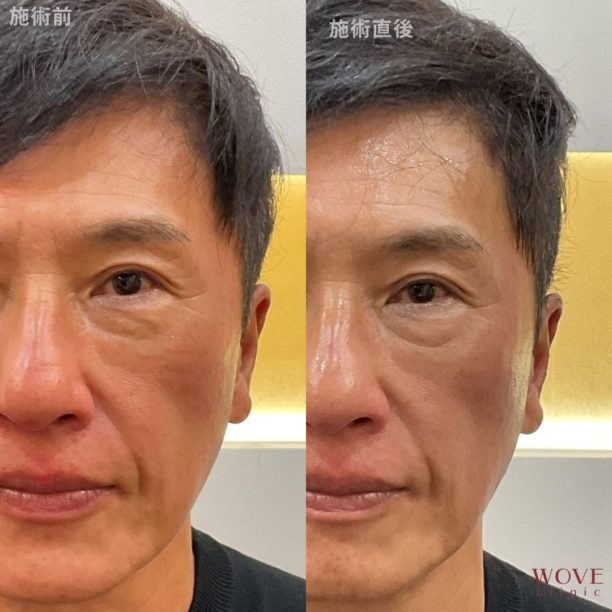 チタニウムリフト（全顔）1回