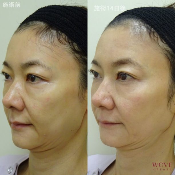 チタニウムリフト（全顔）1回