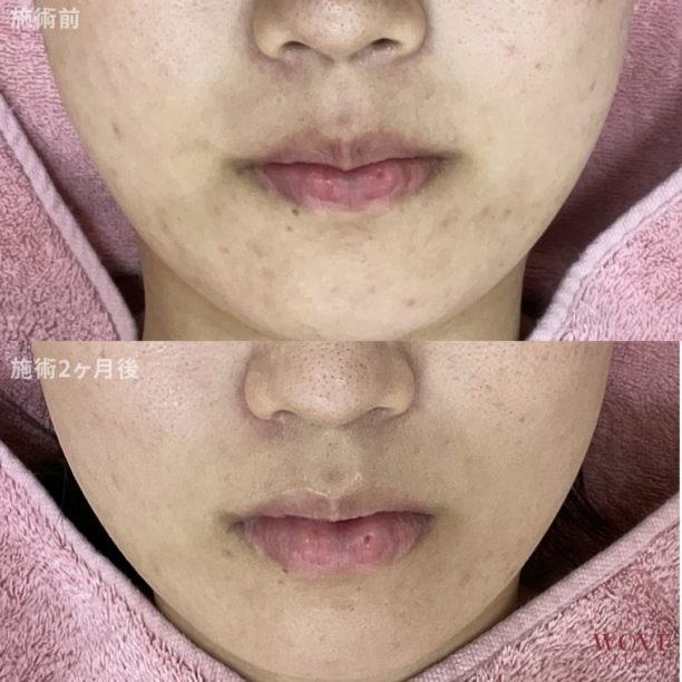 肌育ポテンツァ（リジュラン）2回