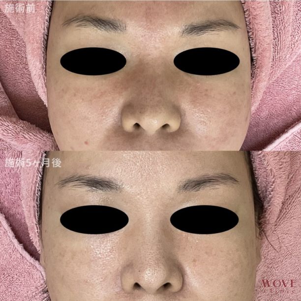 赤みポテンツァ（全顔）5回