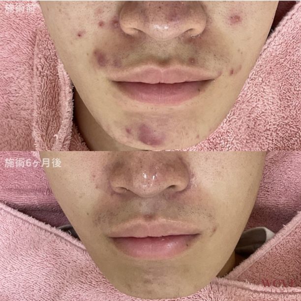 肌育ポテンツァ（ジュベルック）4回・ケミカルピーリング＆導入1回