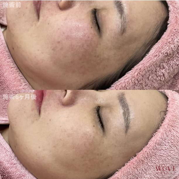 赤みポテンツァ（全顔）5回・肝斑レーザートーニング（ピコトーニング）＆トラネキサム酸導入（全顔・上下眼瞼）4回