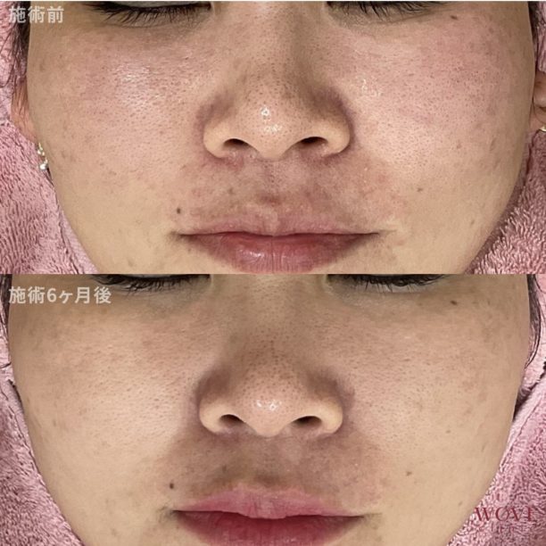 赤みポテンツァ（全顔）5回・肝斑レーザートーニング（ピコトーニング）＆トラネキサム酸導入（全顔・上下眼瞼）4回