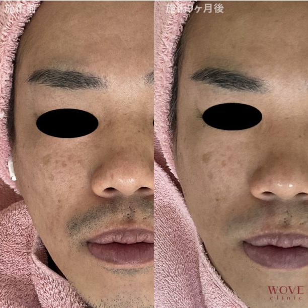 肌育ポテンツァ（マックーム）5回