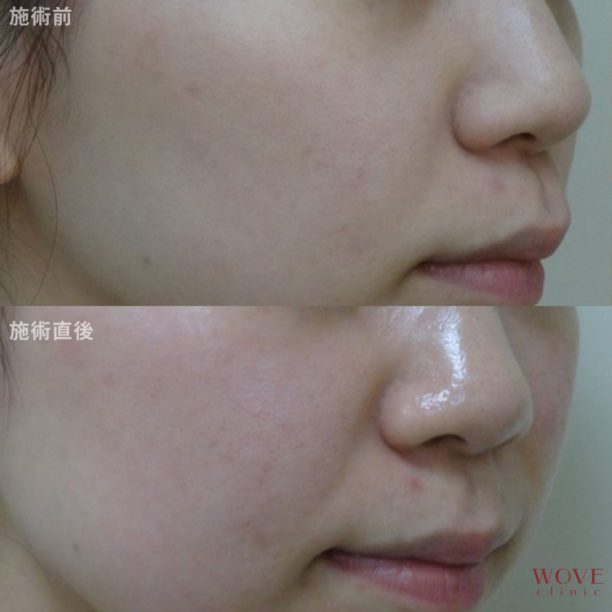 マッサージピール（全顔）1回