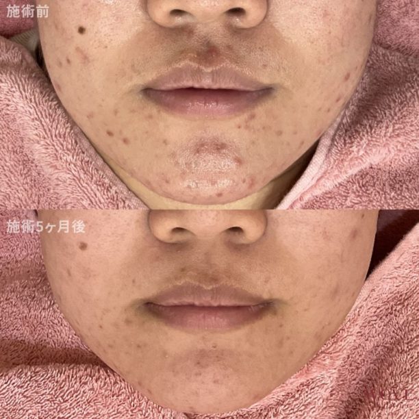 レーザーフェイシャル（全顔・顎裏）5回・ケミカルピーリング＆導入（全顔）5回