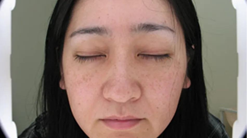 左右対称にもやっと広がっている肝斑