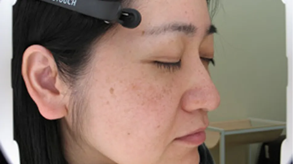 頬の上あたりに肝斑の症状