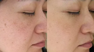 肝斑治療の症例を見る