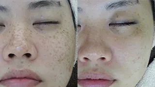 シミ治療の症例を見る