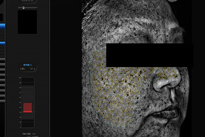 紫外線ジミ(隠れジミ)