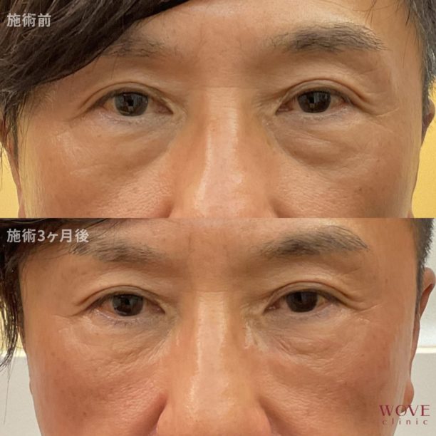 ヒアルロン酸注入・ベビーコラーゲン注射（目元）