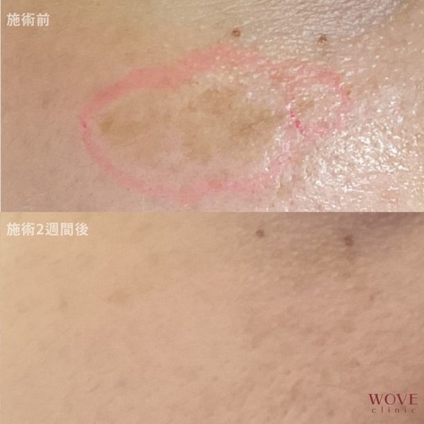 ピコシミ取りレーザー