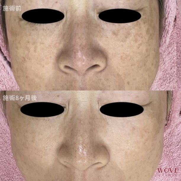 肝斑ポテンツァ3回＆肝斑レーザートーニング（ピコトーニング）+トラネキサム酸導入4回＆ピコシミ取りレーザー1箇所＆高濃度VC点滴9回＆ケミカルピーリング・フォトRFオーロラ・導入1回