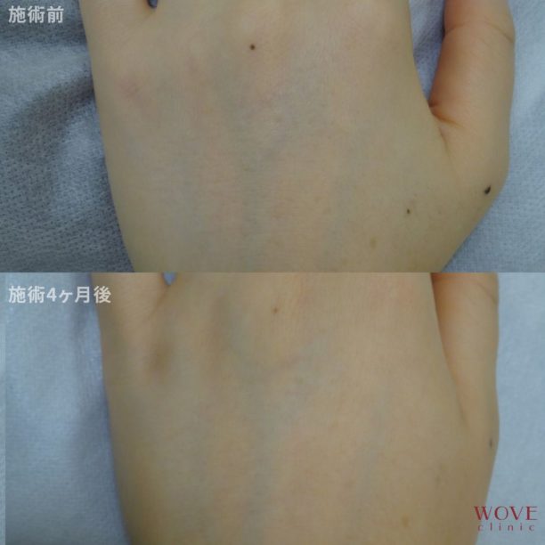 フォトRFオーロラ（手の甲）5回