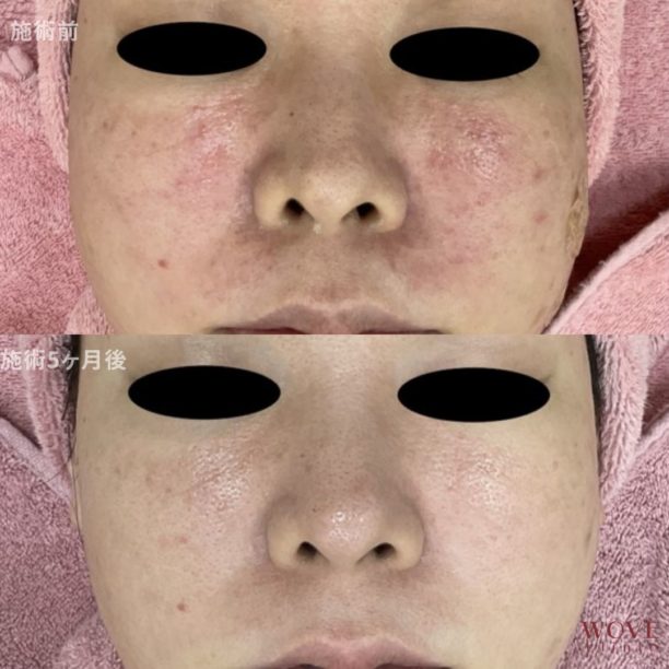 フォトRFオーロラ（全顔）5回