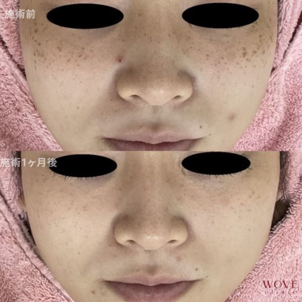 フォトRFオーロラ＆トラネキサム酸導入（全顔）1回