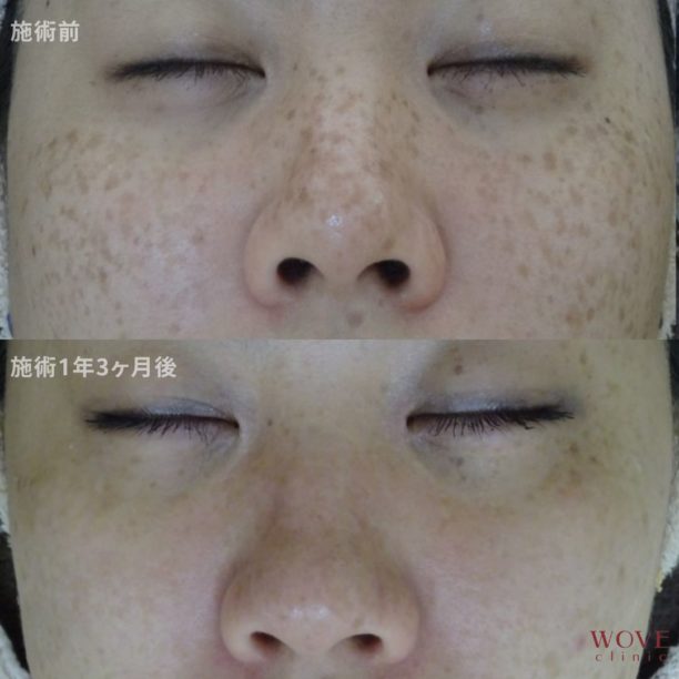 フォトRFオーロラ（全顔）15回