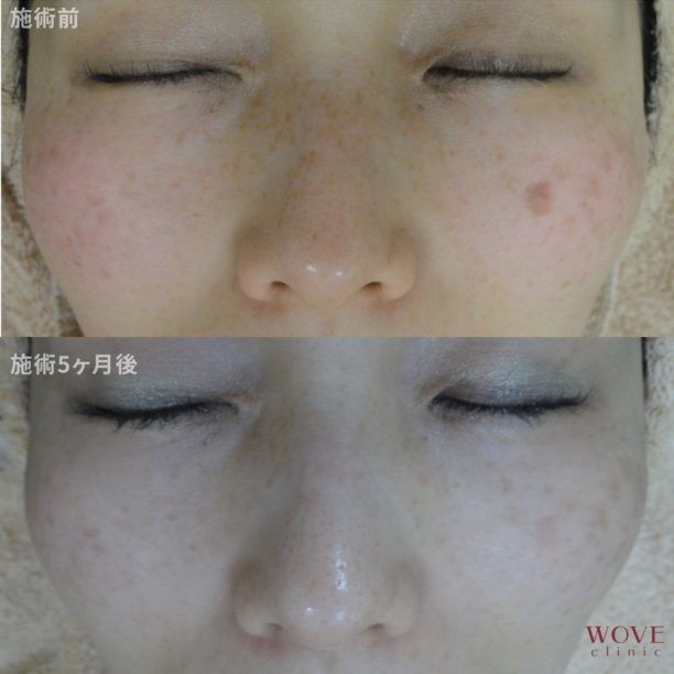 フォトRFオーロラ（全顔）5回・シミ取りレーザー1回