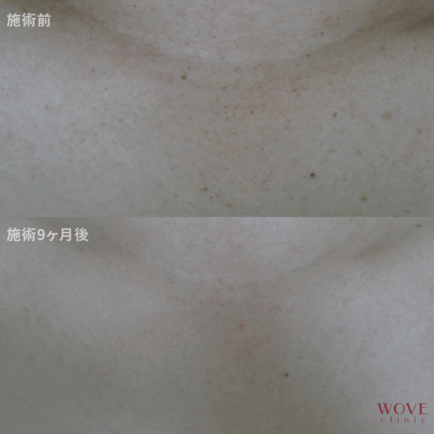 フォトRFオーロラ（デコルテ）4回