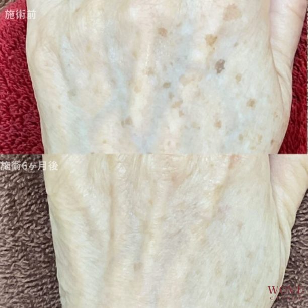 フォトRFオーロラ（手の甲）4回