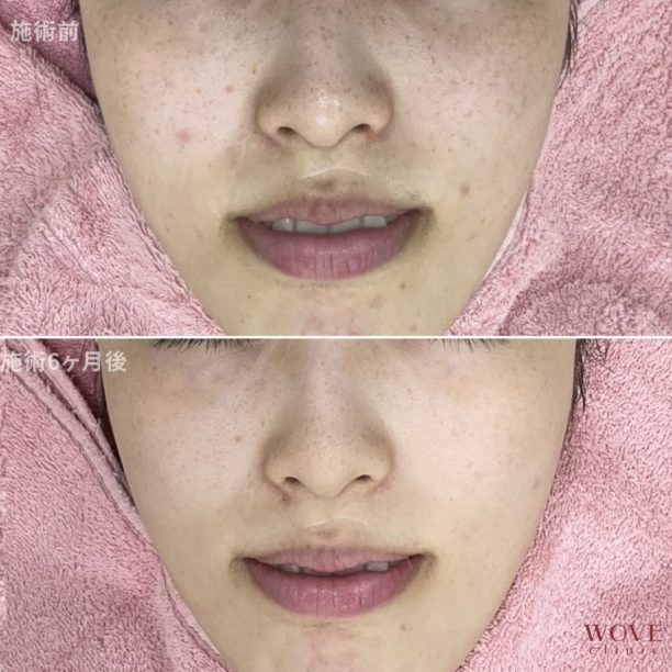 フォトRFオーロラ（全顔）4回