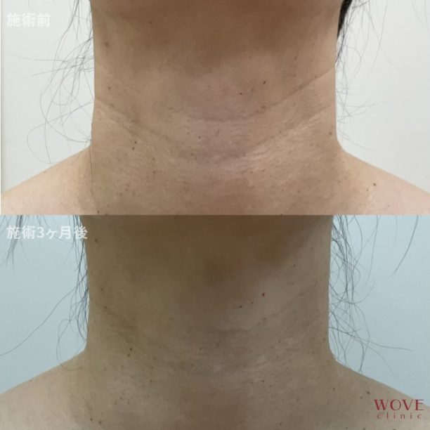 ヒアルロン酸注入（ジュビダームビスタボライトXC）首