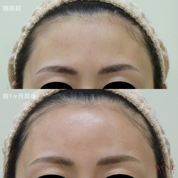 ヒアルロン酸注入（額）