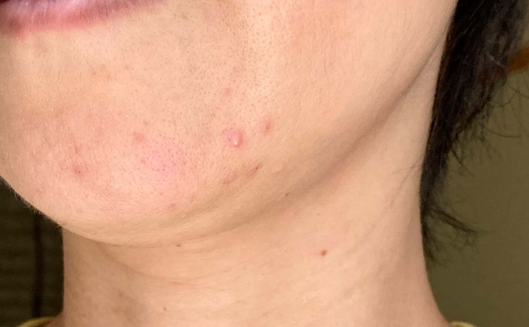 大人ニキビの特徴