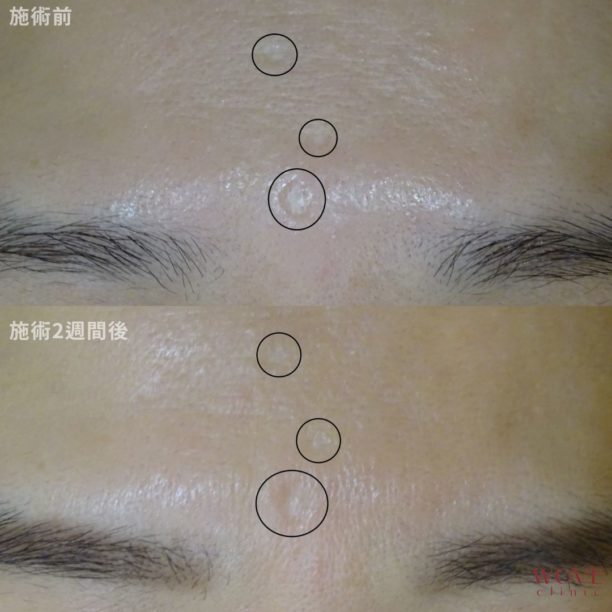 マッサージピール（マイクロニードル）1回