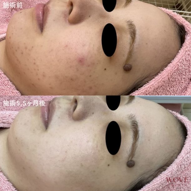 レーザーフェイシャル（両頬）5回・ケミカルピーリング＆ビタミンC導入（全顔）4回