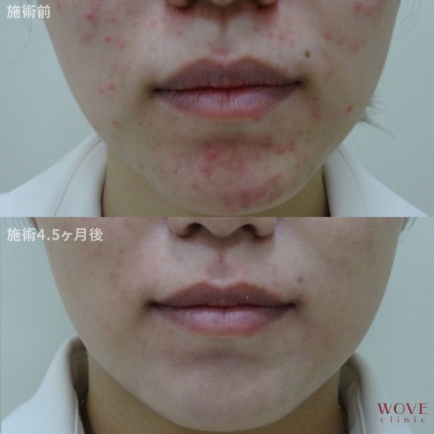 レーザーフェイシャル（全顔）4回・ケミカルピーリング＆導入（全顔）5回