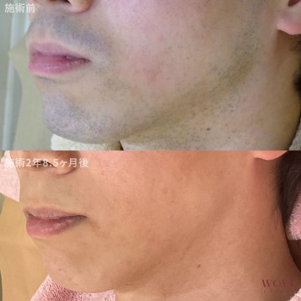 医療レーザー脱毛（口周り・顎裏）19回　（両頬）10回