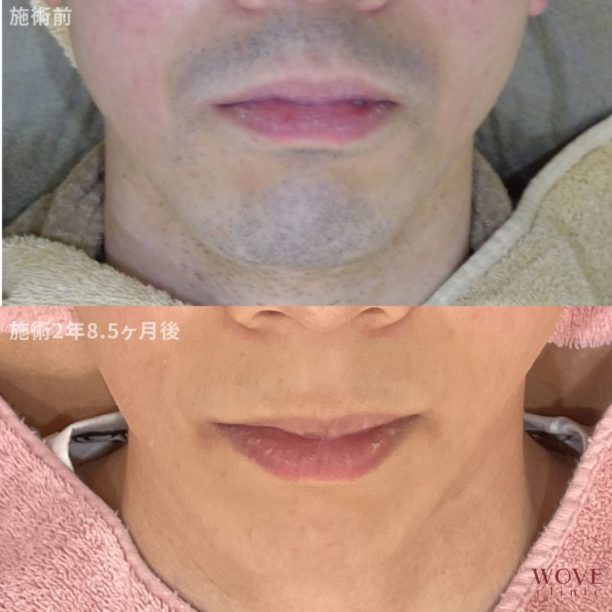 医療レーザー脱毛（口周り・顎裏）19回　（両頬）10回
