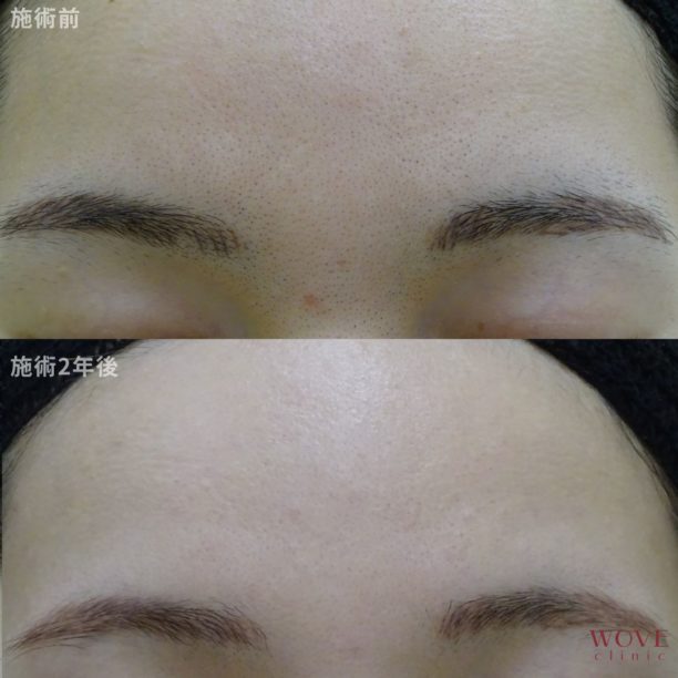 医療レーザー脱毛（全顔）7回