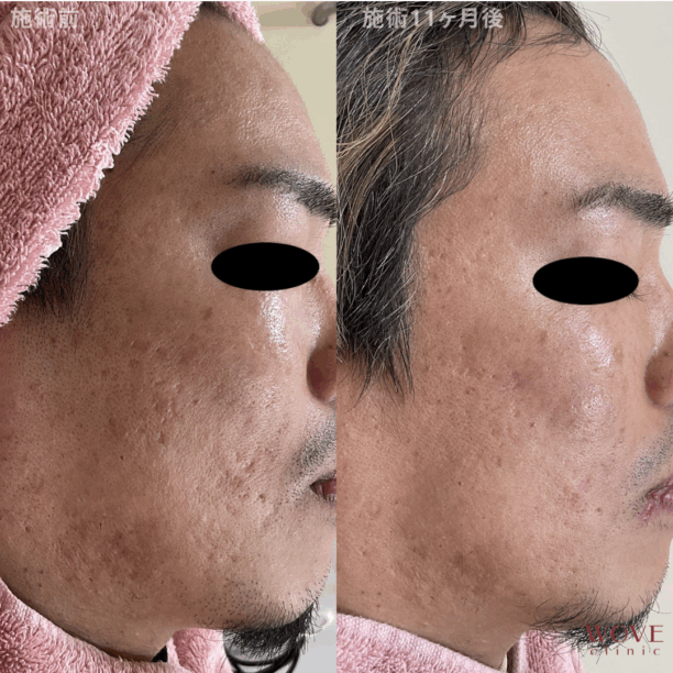 肌育ポテンツァ（マックーム）5回