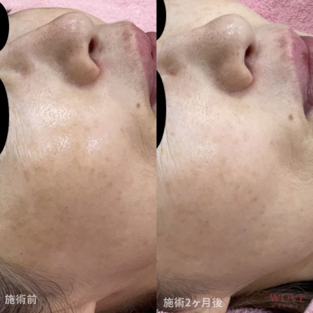 ピコダブル（全顔）2回