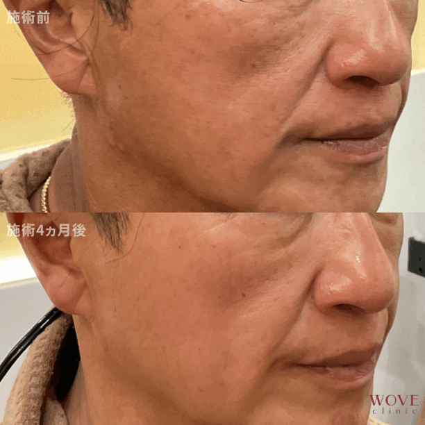 肌育ポテンツァ（ジュべルック1回）＆チタニウムリフト（全顔）1回