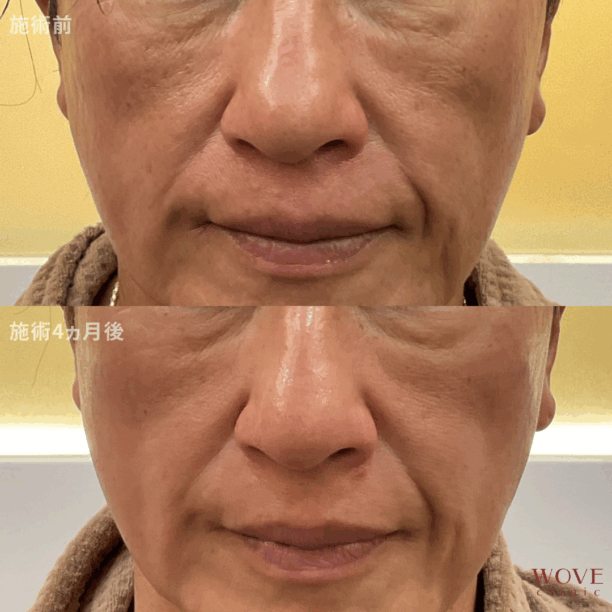 チタニウムリフト（全顔）1回＆肌育ポテンツァ（ジュべルック1回）