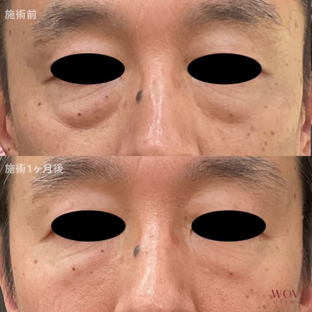 ヒアルロン酸注入（目元）1回