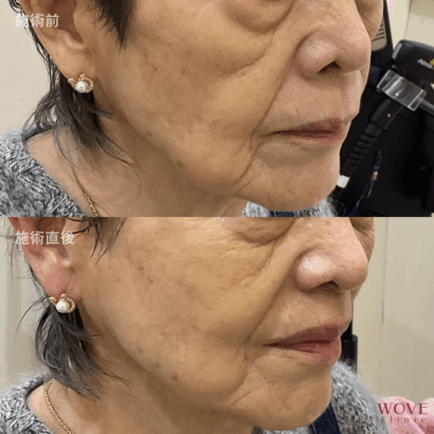 チタニウムリフト（全顔）1回