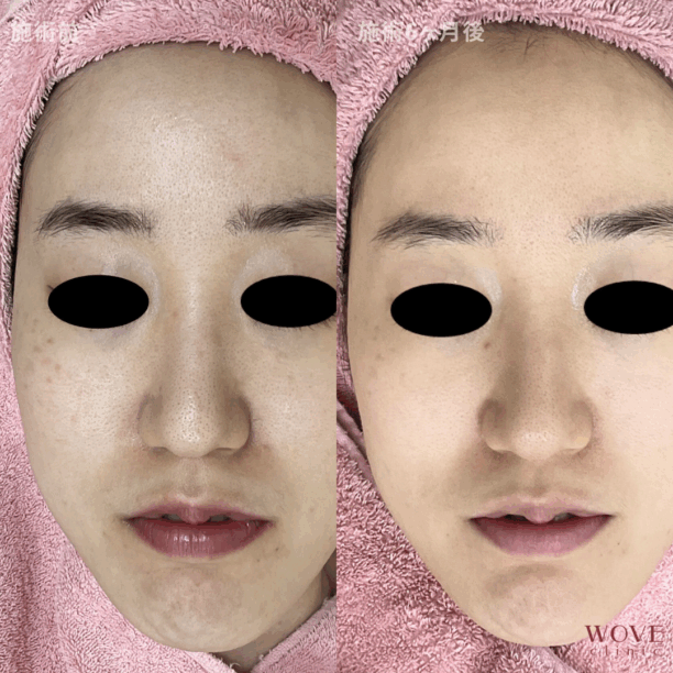 肌育ポテンツァ（マックーム）5回・ケミカルピーリング＆導入5回・シミ取りレーザー