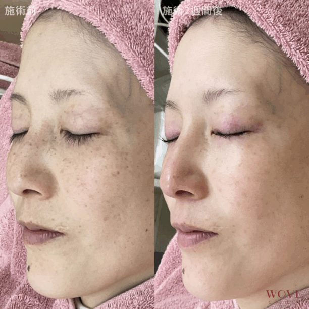 ルメッカ（全顔）1回