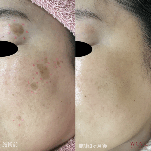 ピコシミ取りレーザー1回